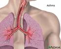 Buy Asthma Inhalers Online  - Mexico Pharmacy