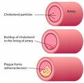 Buy Medication to Lower Cholesterol  - Mexico Pharmacy